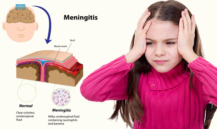 Cuidados para evitar meningite em crianças